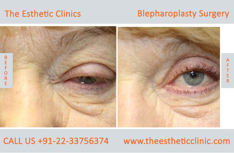 Blepharoplasty Surgery, Eyelid lift surgery before after photos in mumbai india (4)